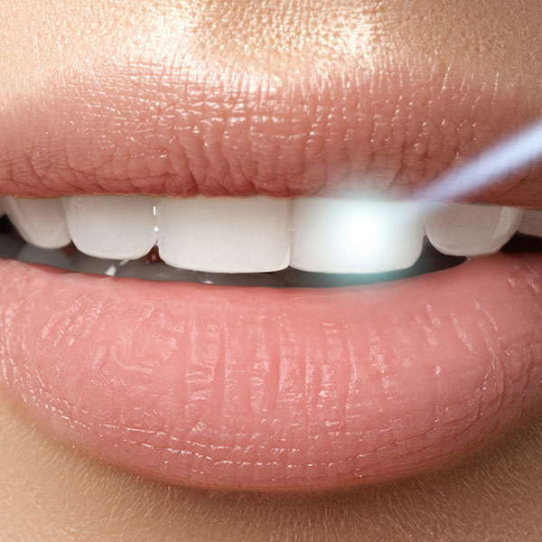 Laser Whitening